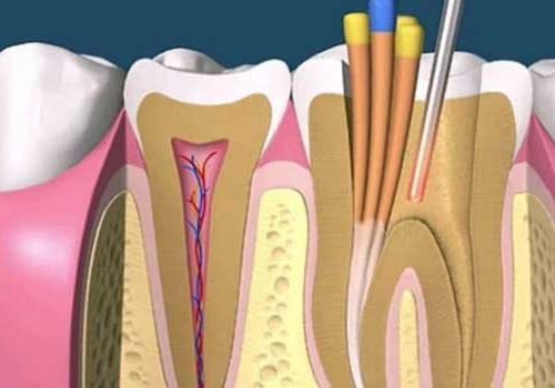 Endodoncias IQDental